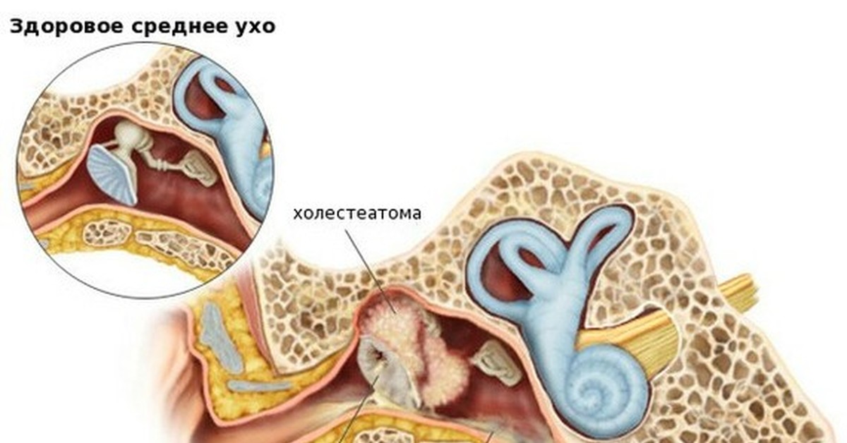 Внутреннее ухо лечение и симптомы. Мезотимпанит барабанная перепонка. Холестеатома слуховых косточек. Холестеатома эпитимпанума. Холестеатома среднего уха на кт.