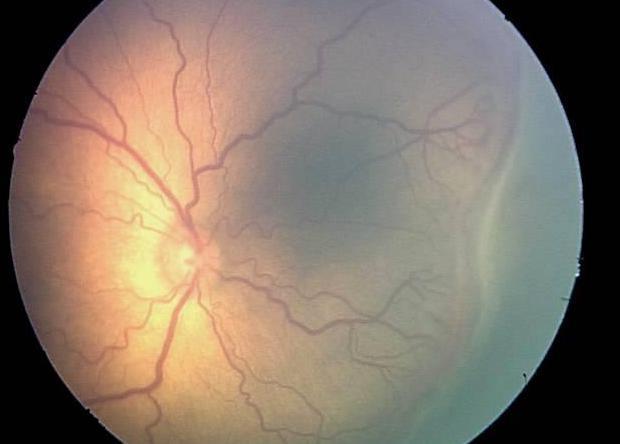 AI outperforms doctors in diagnosing retinopathy of prematurity - The science, news, The medicine, Technologies, Artificial Intelligence, Retinopathy