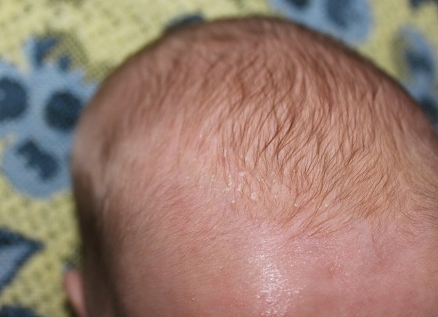 Cухая кожа у новорожденного: причины, симптомы и лечение сухости кожи у грудничка | MUSTELA