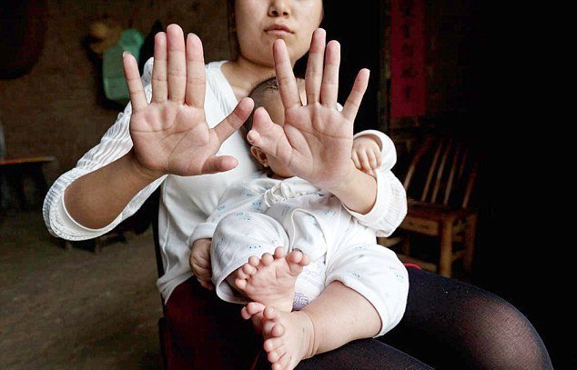 A boy with 31 fingers was born in China (5 photos) - Interesting, Facts, Peace, Interesting people, People, China, Fingers, Disease, Longpost