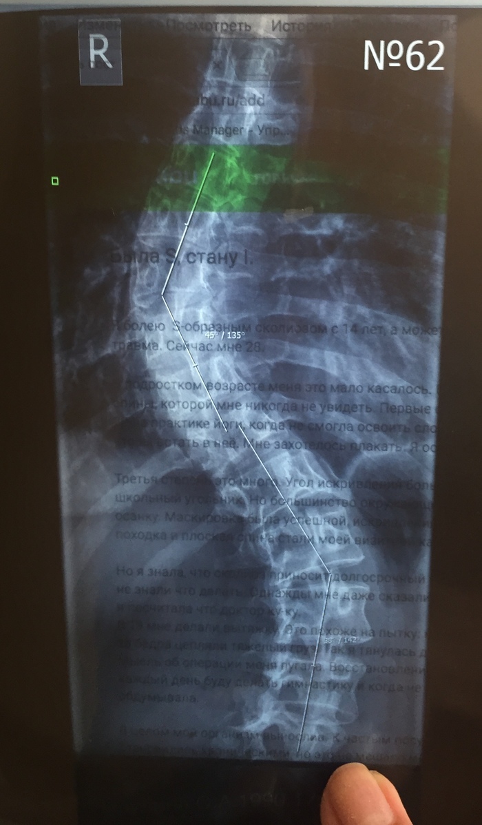 Was S, I will become I. - My, Scoliosis, Disease history, Motivation, Life stories, Longpost