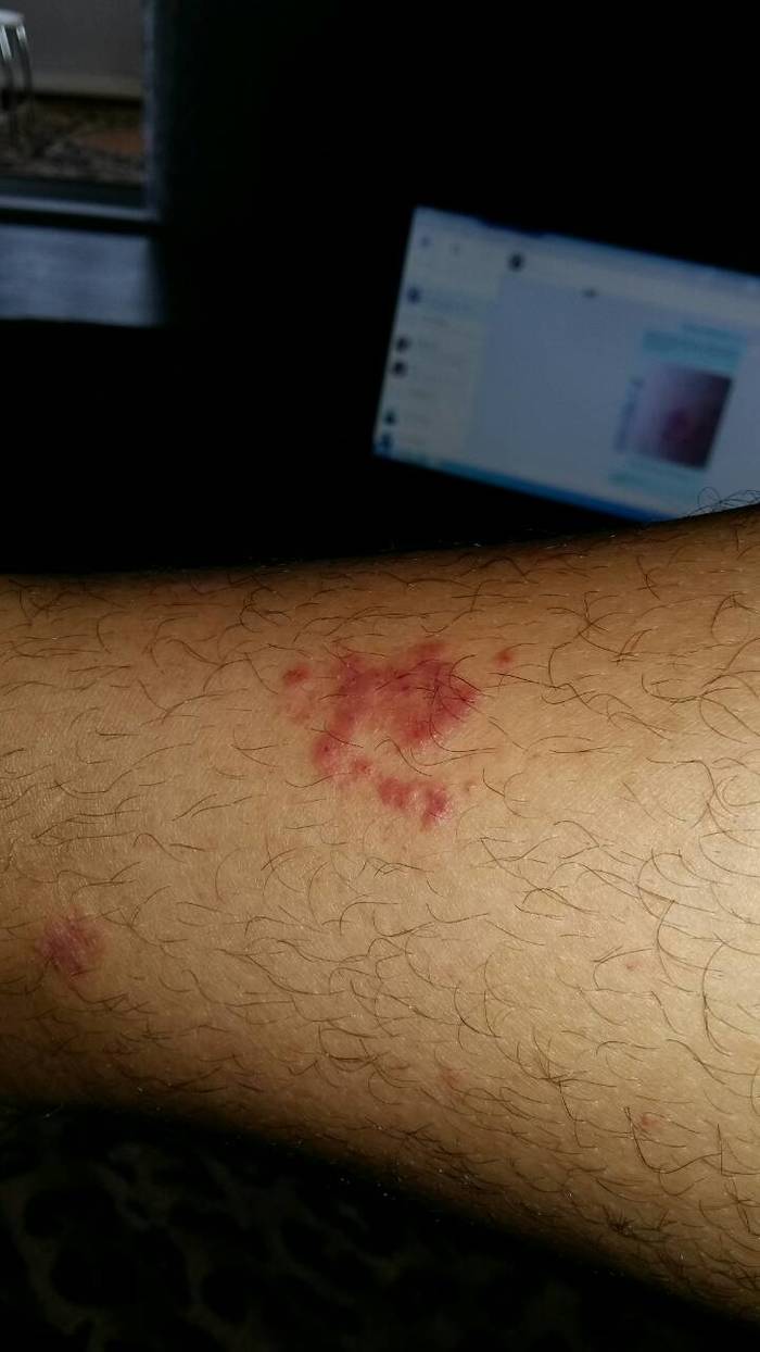 Tell me who bit / what kind of sore - My, Bite, Allergy, Blisters, Longpost