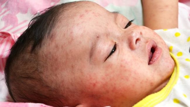 37 deaths from measles in Europe: doctors explain the record outbreak of the disease by refusals of vaccinations - Graft, Anti-vaccines, Measles, Infection, WHO, Vaccination