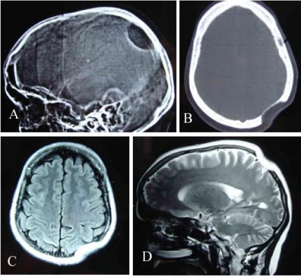 Vanishing bone syndrome - Disease, Bones, Longpost, The medicine