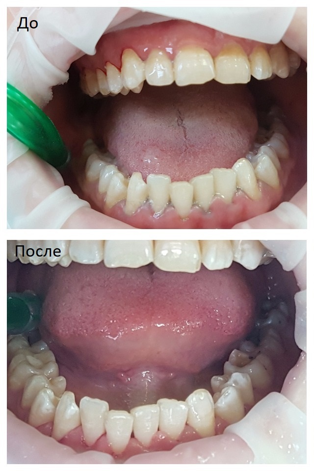 Гигиена полости рта до или после лечения зубов thumbnail