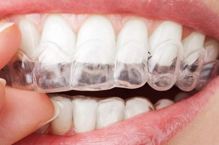 Aligners. Personal experience - Longpost, Aligners, Bite correction, Malocclusion, Personal experience, My