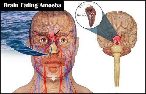 Amoeba turned a woman's brain into porridge while she was still alive - My, Amoeba, Informative, The medicine, The science, Longpost