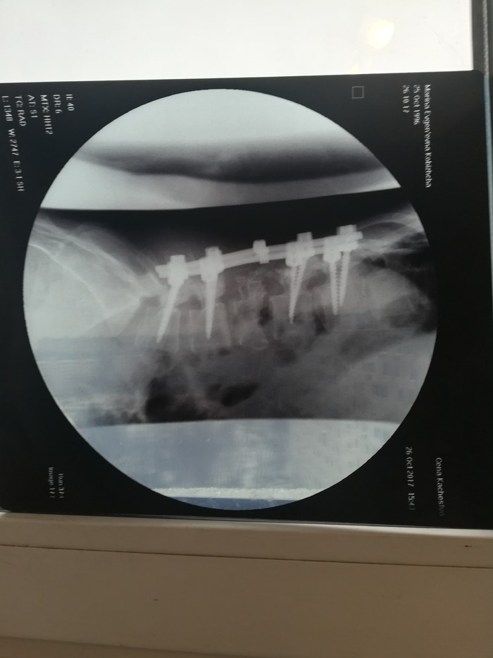 Cheerful family! - , My, X-ray, Fracture, Spine