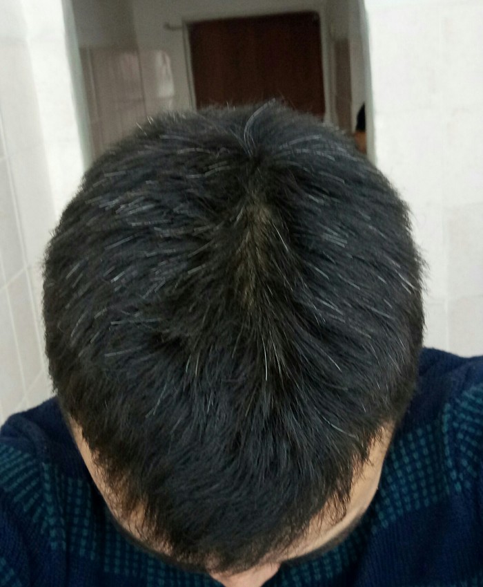 Am I going bald - My, Baldness, Need advice, What to do, Longpost