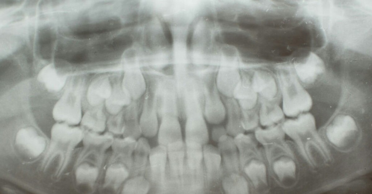 Детский череп рентген. Рентген челюсти ребенка с молочными зубами. Панорамная рентгенография нижней челюсти. Панорамный снимок ВНЧС. Рентген челюсти новорожденного.