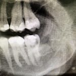 CHLH or not CHLH? That is the question… - My, Dentistry, Extraction of teeth, Teeth, Wisdom tooth, Maxillofacial Surgery, Surgeon, The medicine, Doctors, Longpost