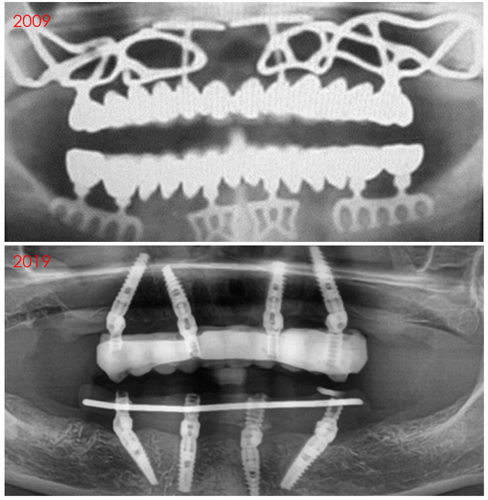 #10yearchallenge in prosthodontics - Dentures, Dentistry, 10yearschallenge