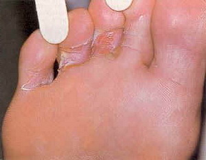 Грибок на ногах: причины, симптомы и лечение