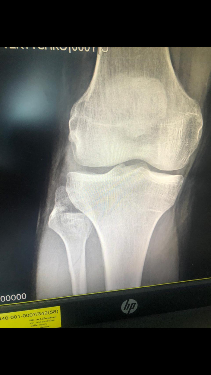 Help, tell me! Is there a fracture? They put a plaster cast on the entire leg. I can’t figure out from the photo where the fracture is and is there one?? - Broken leg, Help me find