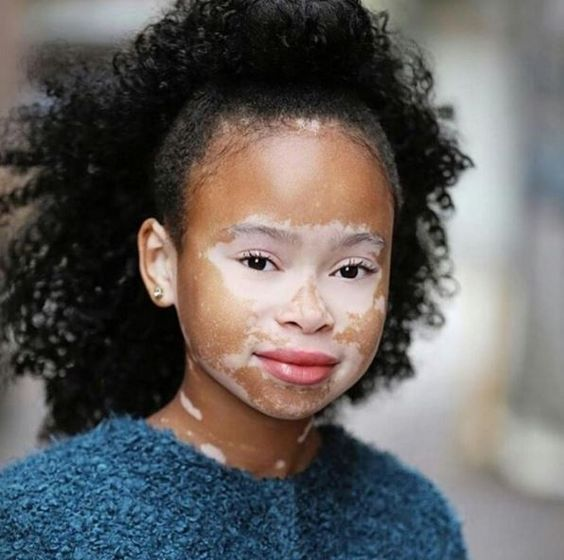 Vitiligo - Skin disease, , Longpost, Dermatology