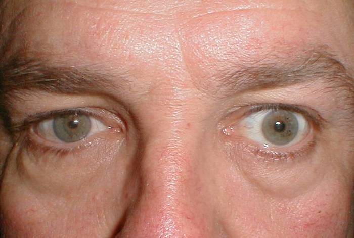"Красивые глаза" как симптом болезни. Медицина, Зрение, Офтальмология, Scientaevulgaris, Длиннопост