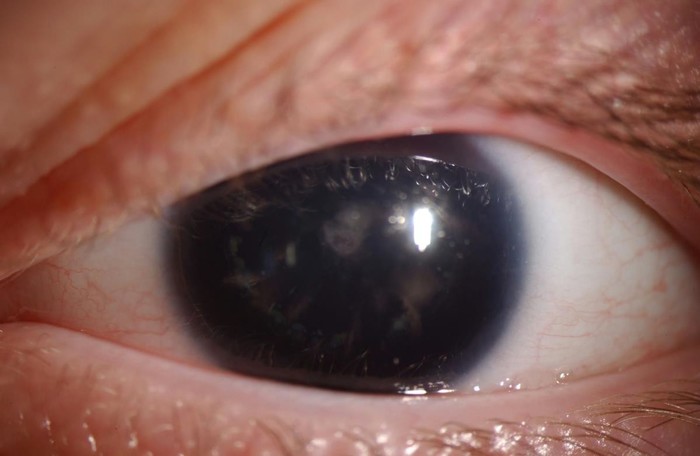 "Красивые глаза" как симптом болезни. Медицина, Зрение, Офтальмология, Scientaevulgaris, Длиннопост
