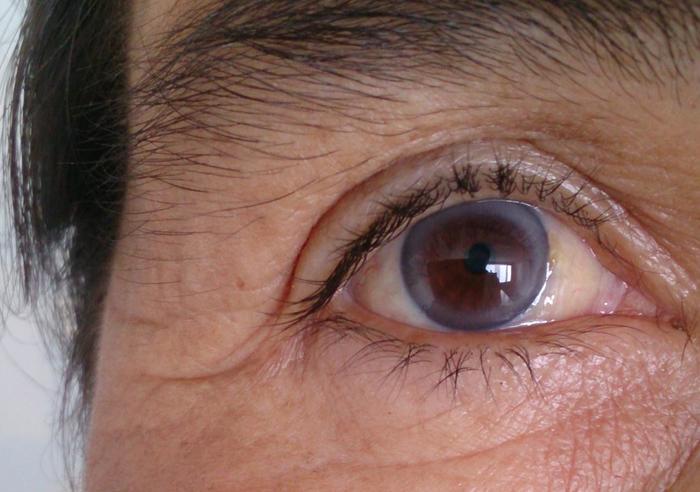Глаза лечение у мужчин фото