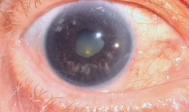 Глаза лечение у мужчин фото