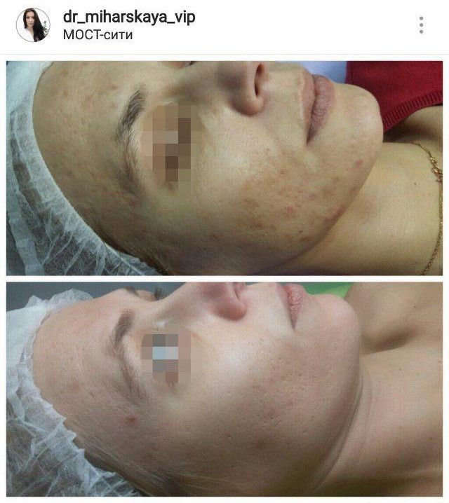 Как выровнять кожу после акне на лице отзывы thumbnail
