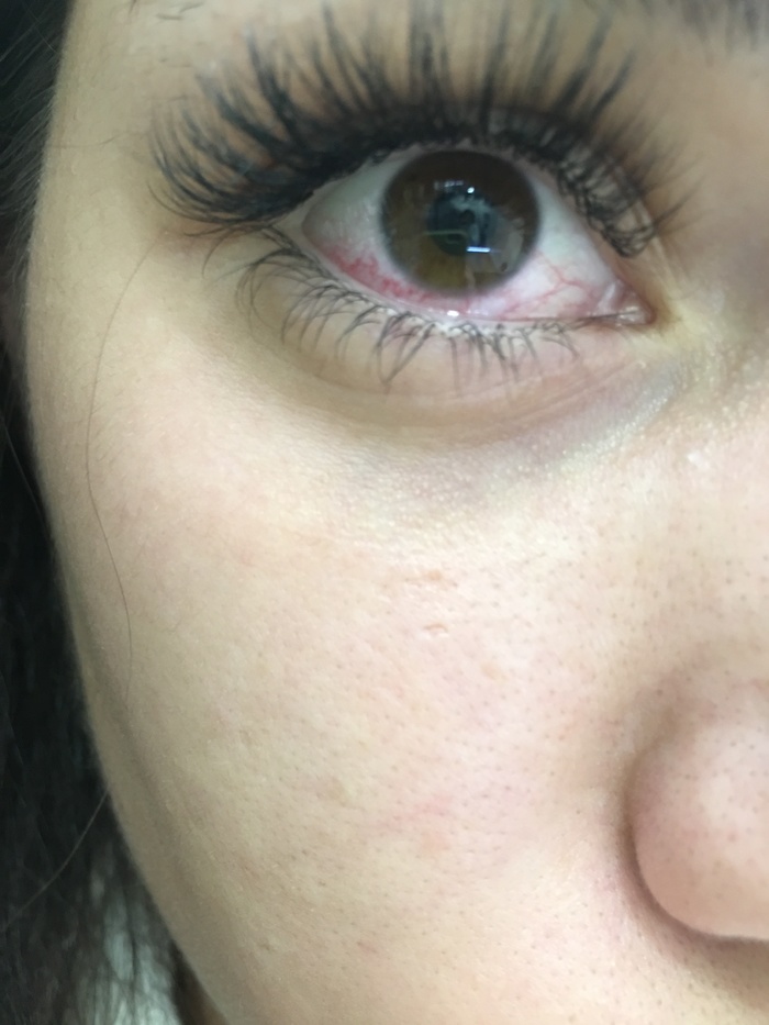 After eyelash extension, the eye turned red and hurts. Any advice on what to share? Drops can help someone in such situations (( - Eyelashes, Redness, Longpost