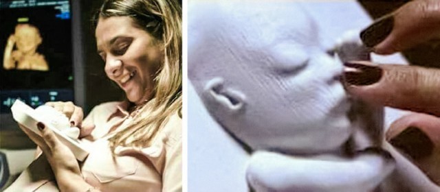 An ultrasound image that doctors made using 3D printing for a blind mother. - The blind, Mum, Ultrasound, Children