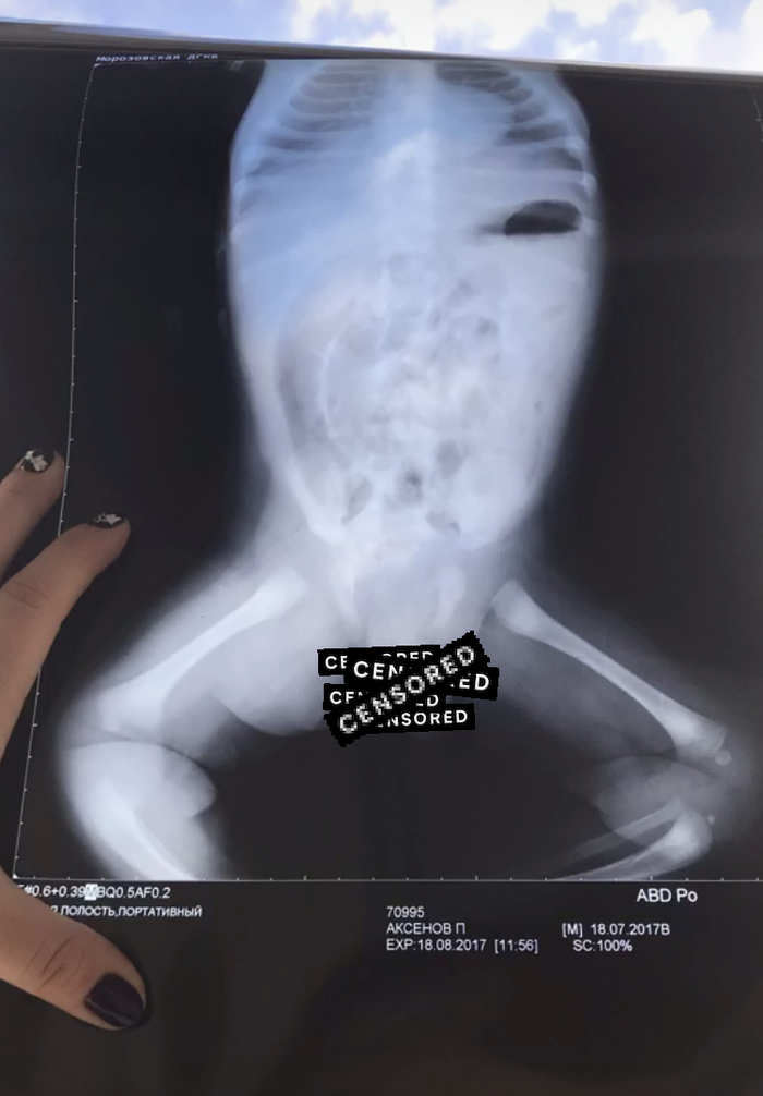 Намеки на коленные чашечки месячного ребёнка.