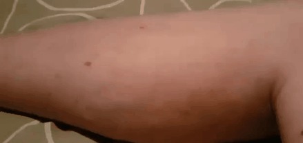 Мышечный спазм