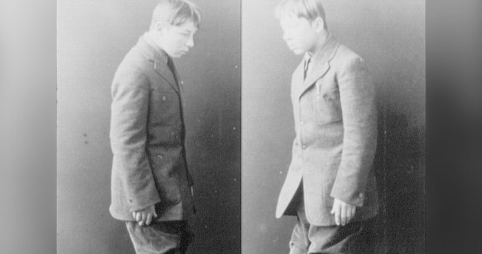 Эпидемия летаргии: заснувшие навсегда. Медицина, История, Эпидемии, Пандемии, Энцефалит, Длиннопост, Scientaevulgaris, Летаргия, Болезнь