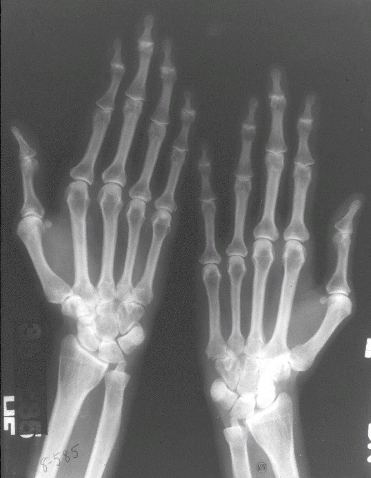 Arachnodactyly (literally spider fingers) - Pathology, Anatomy, Longpost