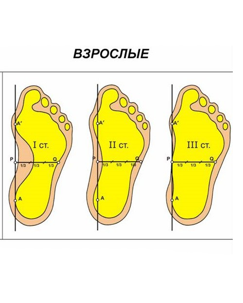 NOT terrible flat feet - My, The medicine, Flat feet, Insoles, Longpost