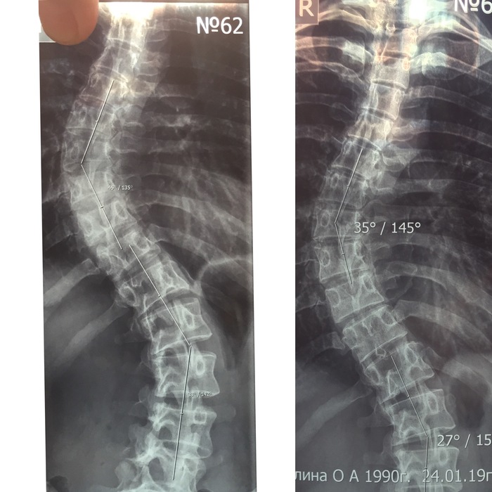 Was S, I will become I. Part 2. - My, Scoliosis, Disease history, Motivation, Life stories, Personal experience, Longpost