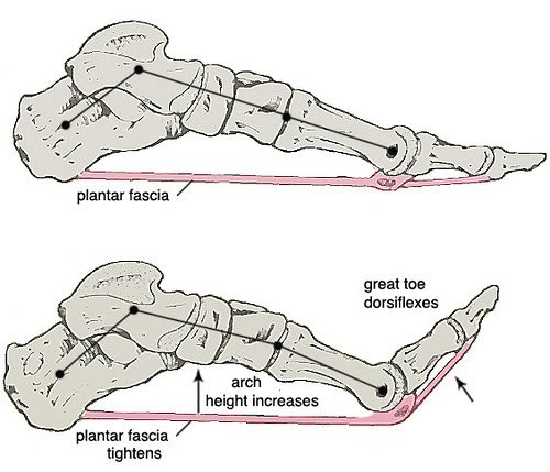 Heel spur - My, The medicine, Surgery, Feet, Longpost