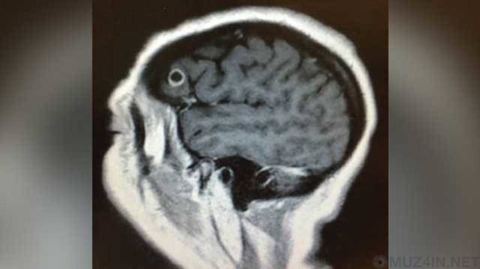 Woman lived for almost a year with a tapeworm in her brain, all the while believing she had a tumor - My, Health, Parasites, People, Life stories, Brain, Longpost