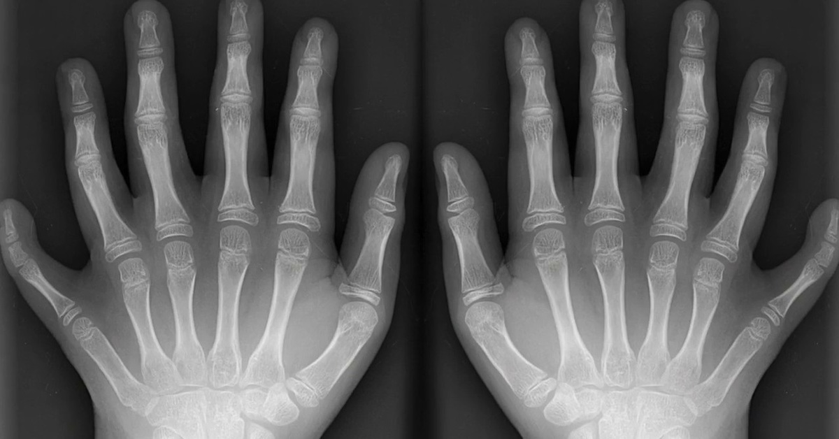 На 1 руке 6 пальцев. Полидактилия кисти рентген. Полидактилия шестипалость. Постаксиальная полидактилия кистей. Полидактилия верхних конечностей.