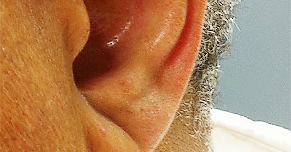 Правда ухо. Диагональные складки на мочках ушей.