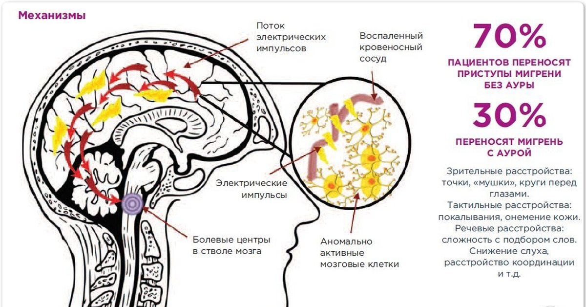 Форум головного мозга. Мигрень с аурой. Зрительная мигрень с аурой. Мигрень с аурой симптомы. Зрительная Аура при мигрени.