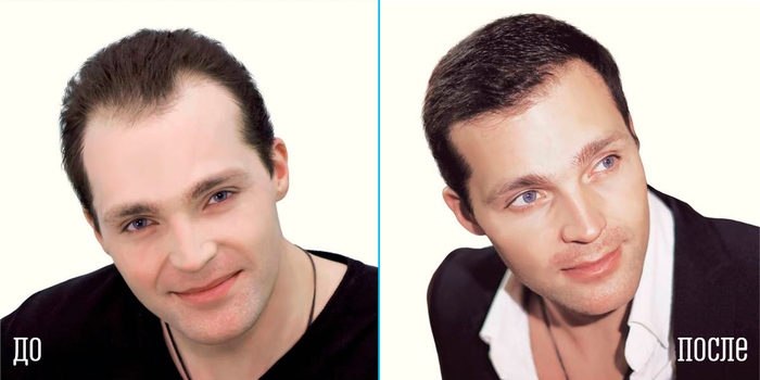 Before-after hair transplant, as promised! - My, Hair Transplant, Hair, The male, , beauty, Cosmetology, Clinic, The medicine, Longpost, Men