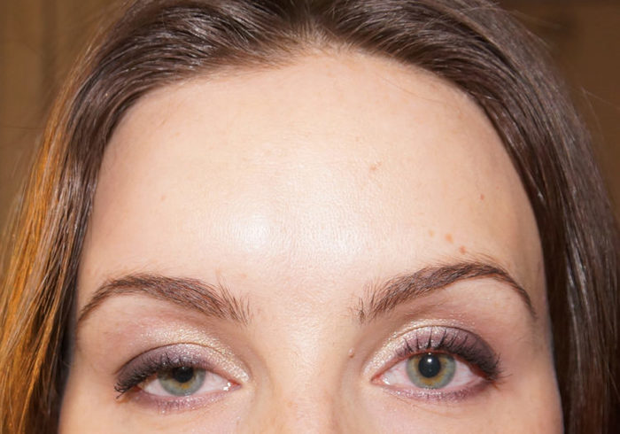 Why do eyebrows droop after Botox? - My, Botox, Consequences, Cosmetology, , Fillers
