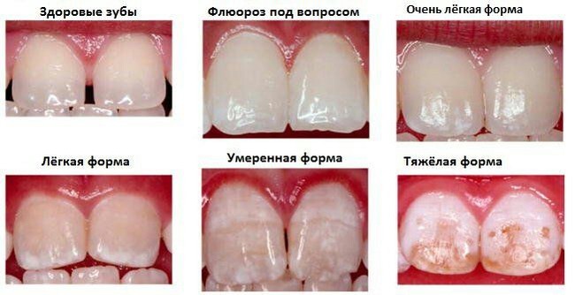 Основные причины разрушения наших зубов. Причины и факторы. Кариес, Стоматолог, Зубы, Длиннопост
