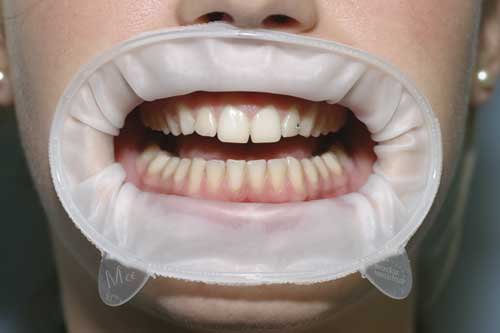 Professional teeth cleaning. - My, Body positive, Teeth, Mat, Longpost, Teeth cleaning, Dentistry