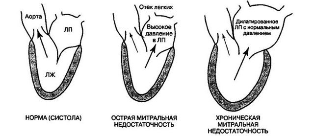 21 сентября - первое протезирование митрального клапана у человека - Сентябрь, Медицина, История, Кардиохирургия, Календарь, Длиннопост