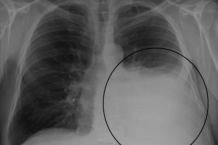 Tuberculosis - My, The medicine, Tuberculosis, Hyde, Mat, Longpost