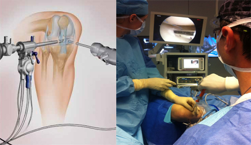 Arthroscopy - My, The medicine, Medicine in Russia, Longpost, Arthroscopy