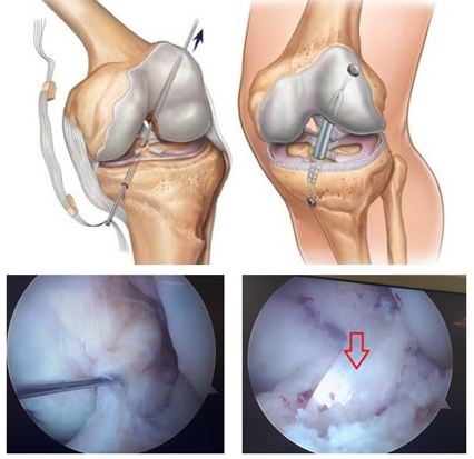 Arthroscopy - My, The medicine, Medicine in Russia, Longpost, Arthroscopy