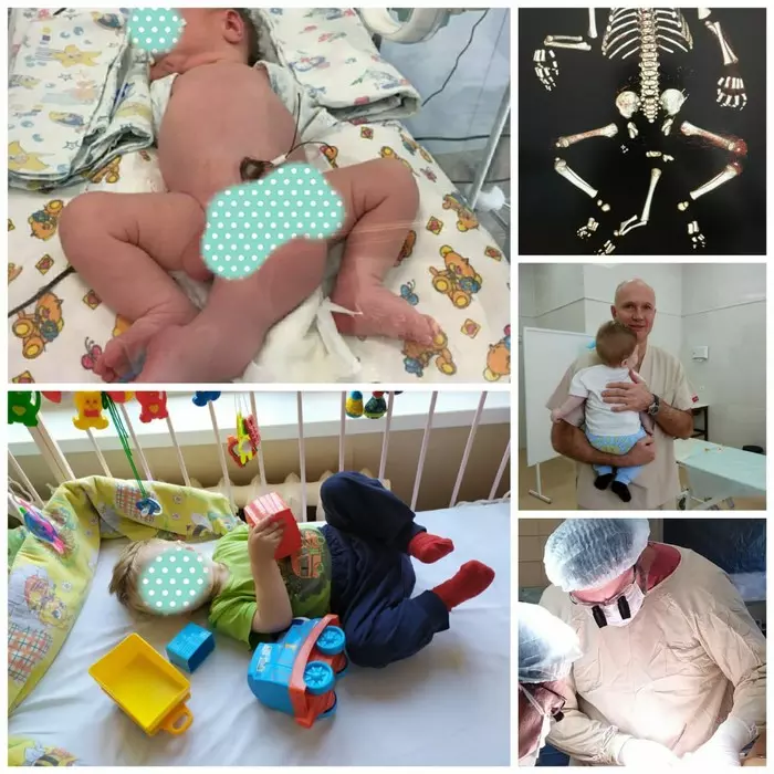 Московские хирурги вернули нормальный вид мальчику, родившемуся с тремя ногами и двумя пенисами Операция, Аномалия, Мутация, Хирургия, Дети
