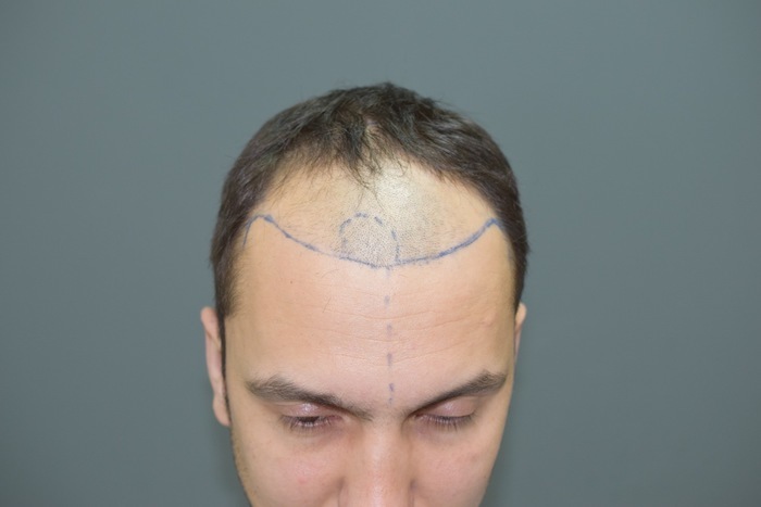 Турецкая пересадка волос. Трансплантация волос в Турции. Операция по пересадке волос.