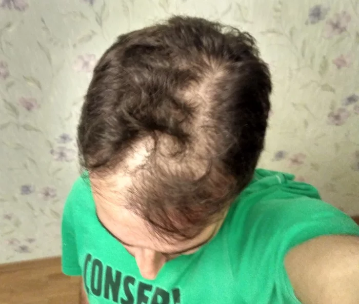 Hair transplantation. - My, Hair Transplant, Minoxidil, Longpost