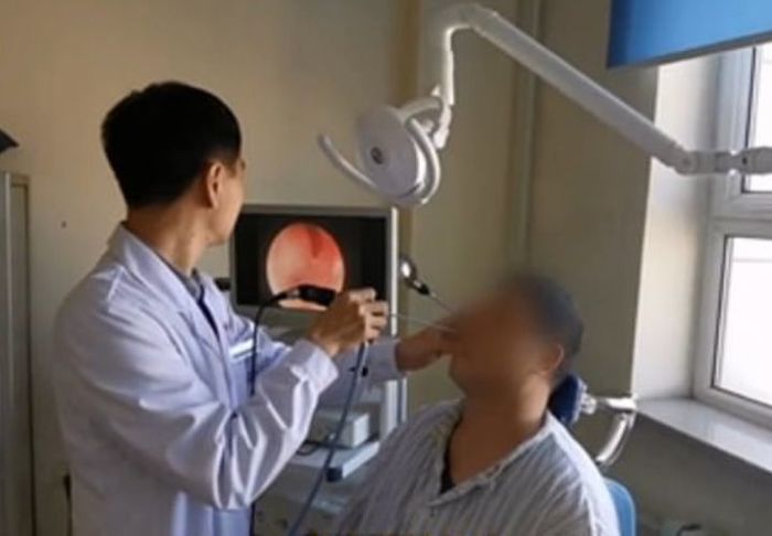 Unsuspecting man lived for decades with a tooth in his nose - The medicine, Curiosity, China