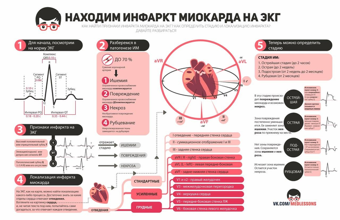 Инфаркт на экг фото